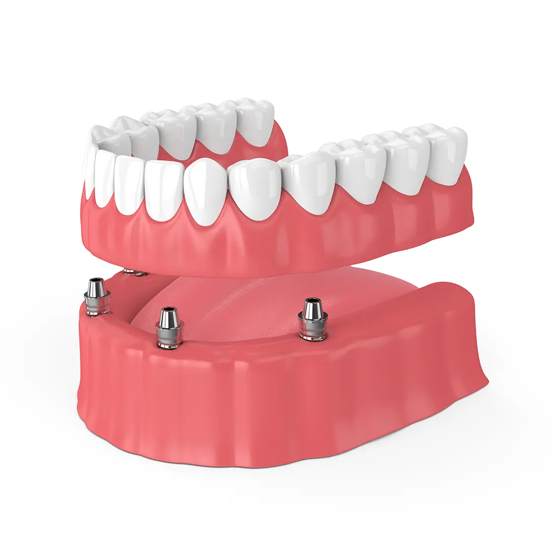 Napa Implant Dentures