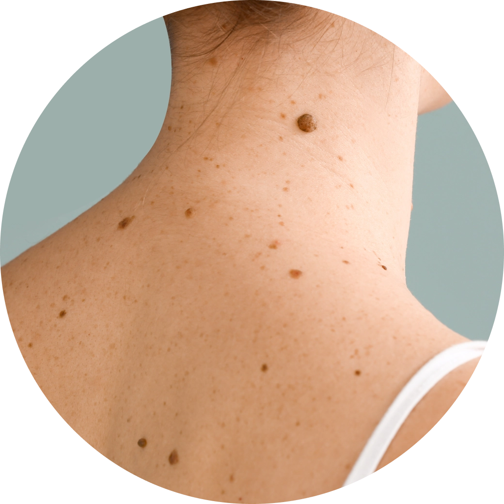 Adelaide Skin Cancer Clinic Cancer Detection Experts