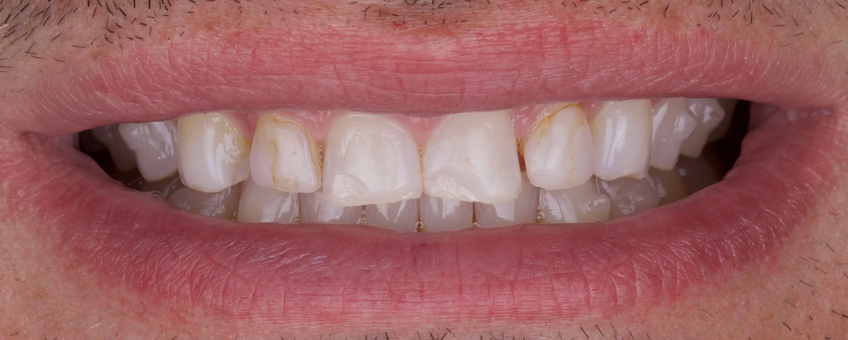Porcelain Veneers in Austin and Central Texas