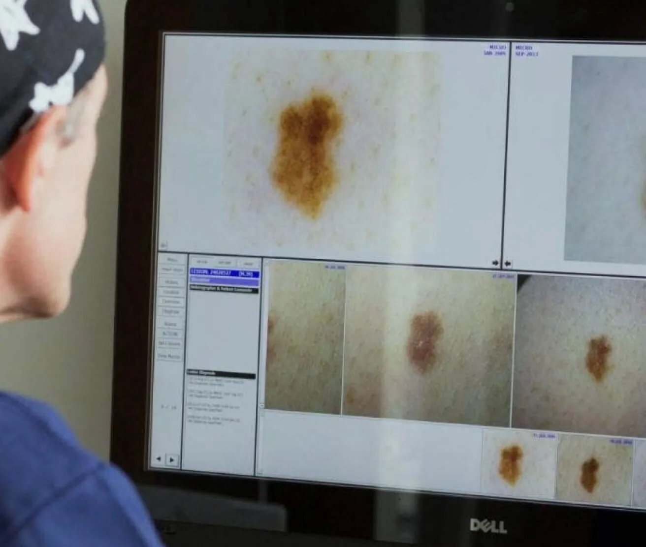 Skin Cancer Check Perth