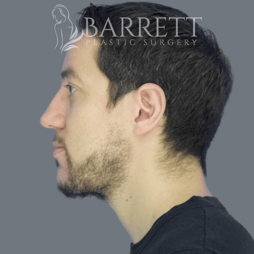 Chin Implants Beverly Hills | Barrett Plastic Surgery