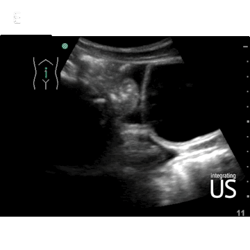 Abdominal Free Fluid LIver Disease Bowel Distension