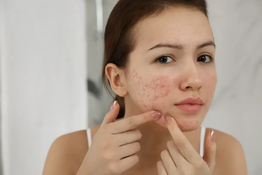 Acne Treatment Center | Manhattan Dermatology