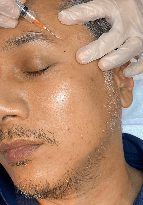 Subcision for Acne Scars Remedy