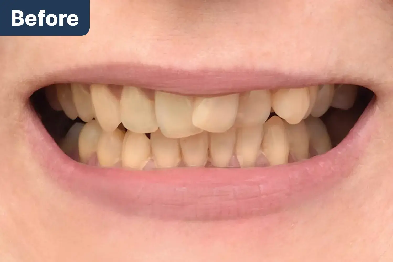 Before and After Dental Gallery Dynamic Dental Design, Covina