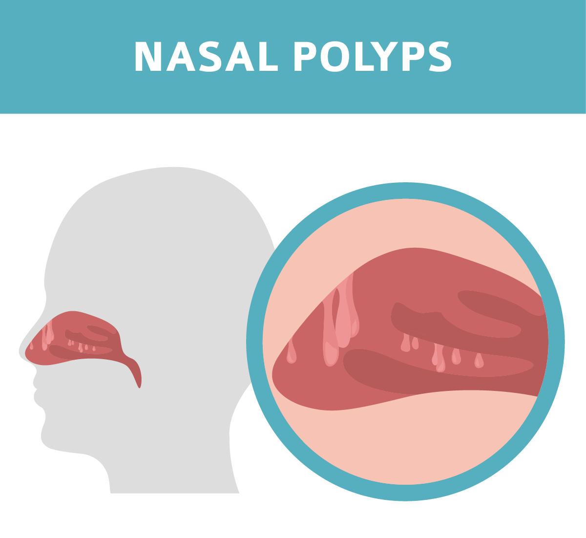 A new treatment for nasal polyps
