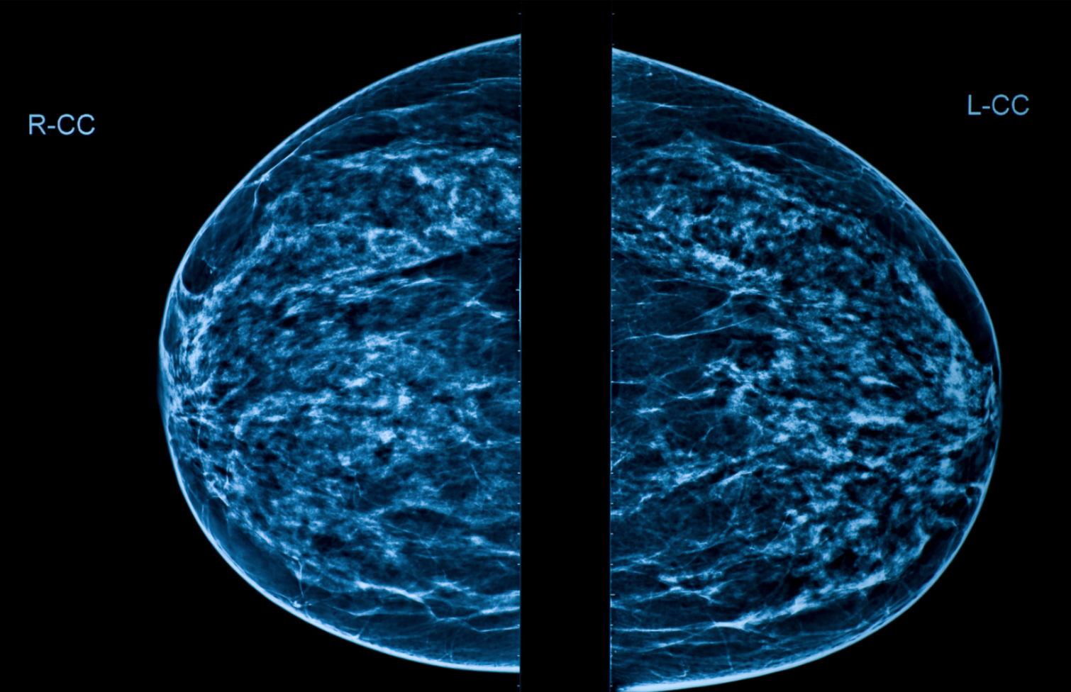 AI Applications in Healthcare: Breast Cancer Prediction