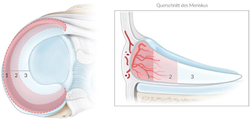IM FOKUS Magazin Meniskusläsion