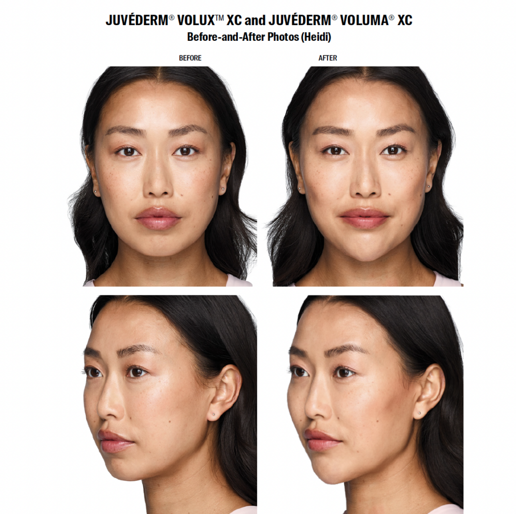 Before And After Photos Of Juvederm Volux Female Patient before-and-after-photos-of-juvederm-volux-female-patient