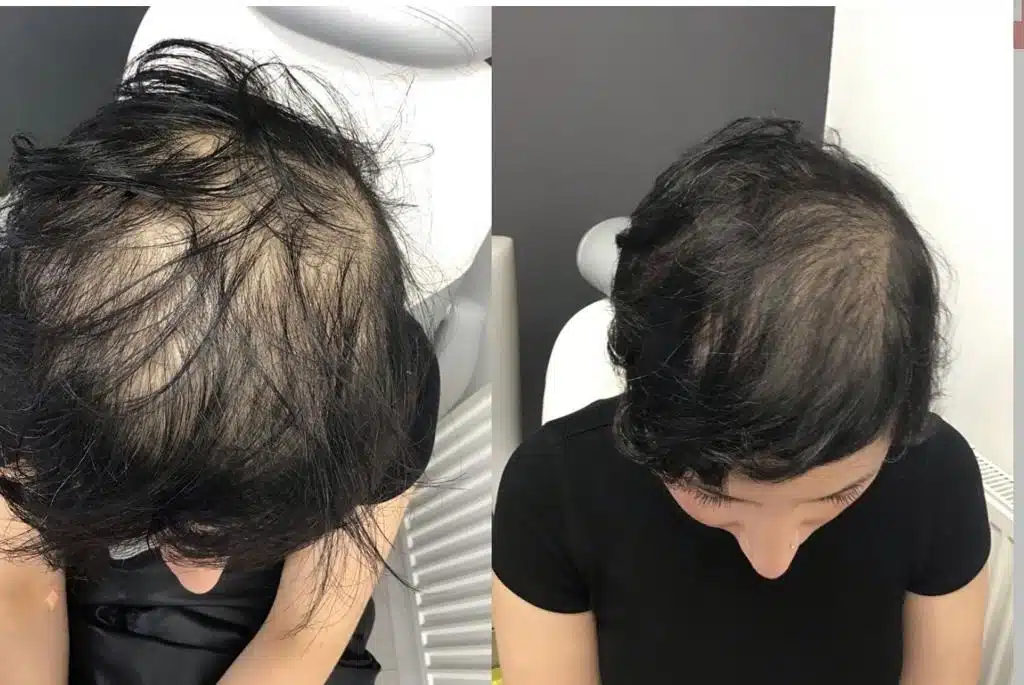 Before and After Este Hair Medical