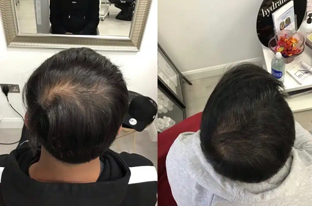 Before and After Este Hair Medical