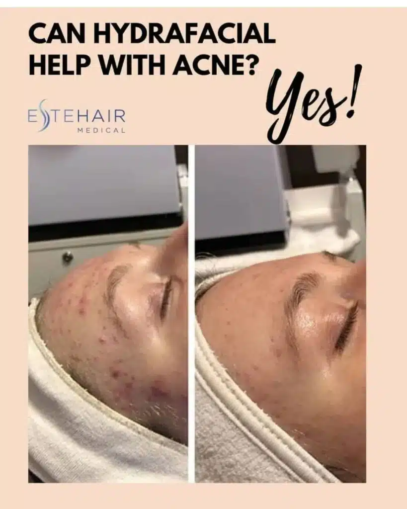 Before and After Este Hair Medical