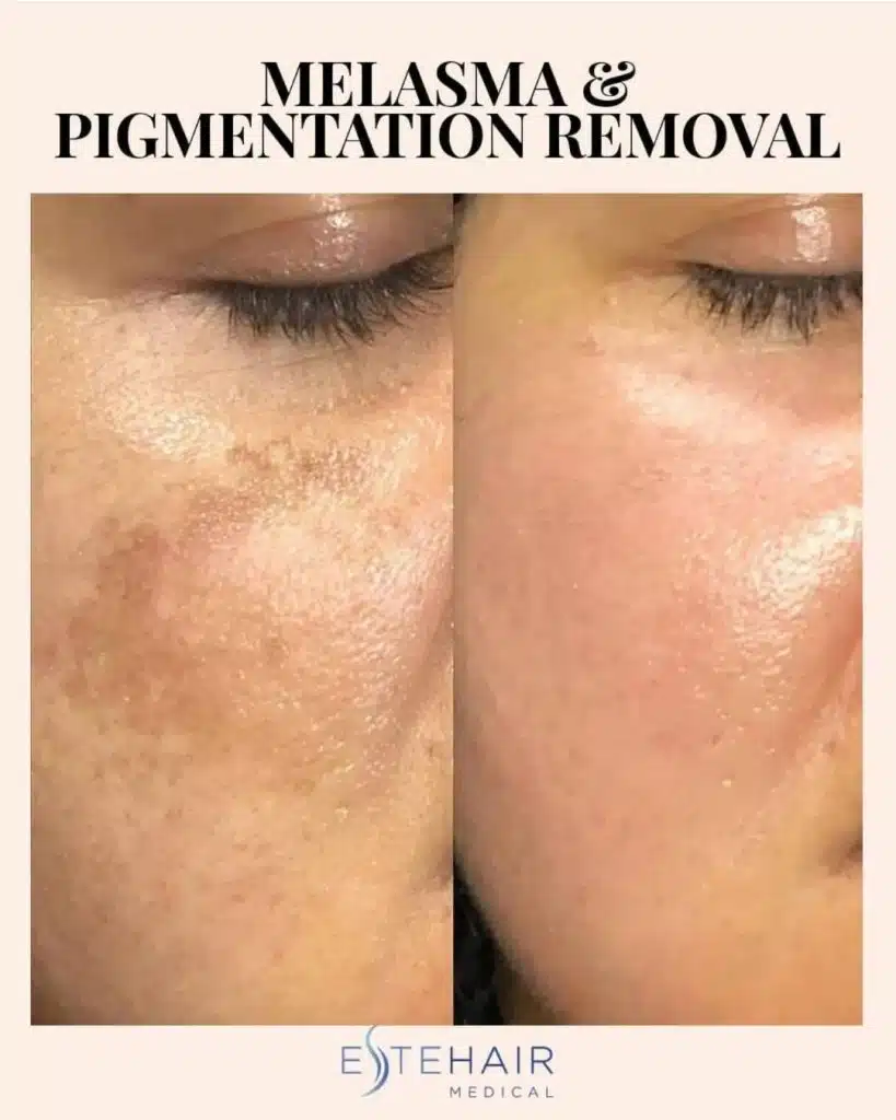 Before and After Este Hair Medical