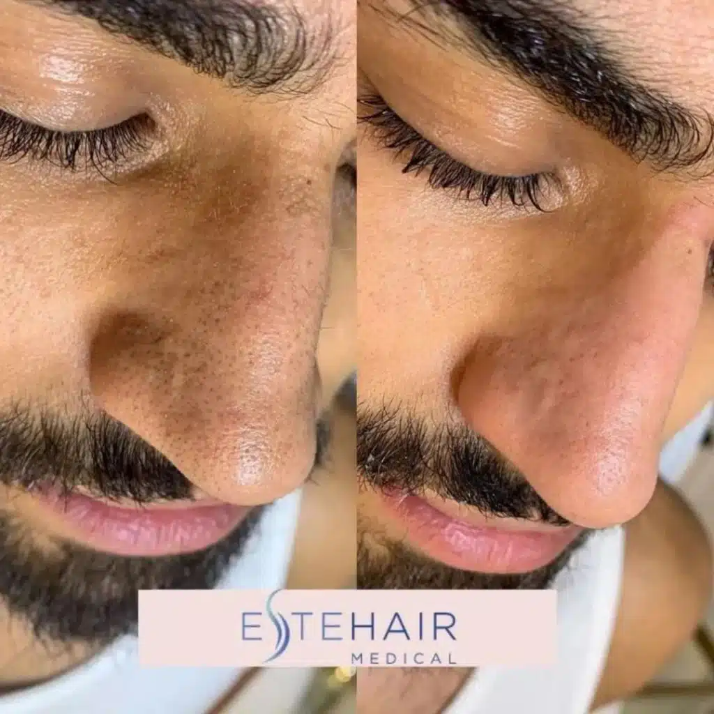 Before and After Este Hair Medical