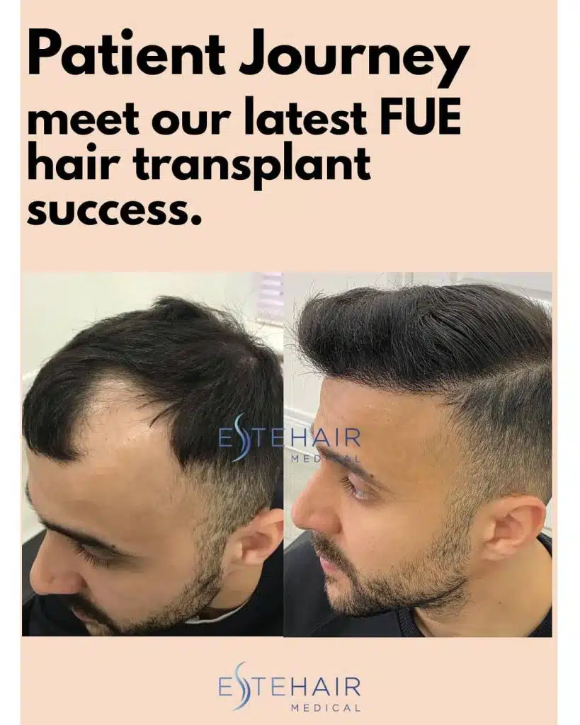 Before and After Este Hair Medical