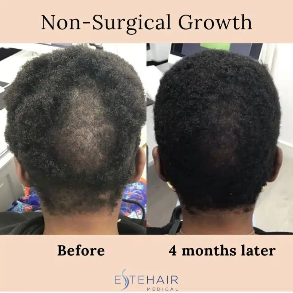 Before and After Este Hair Medical