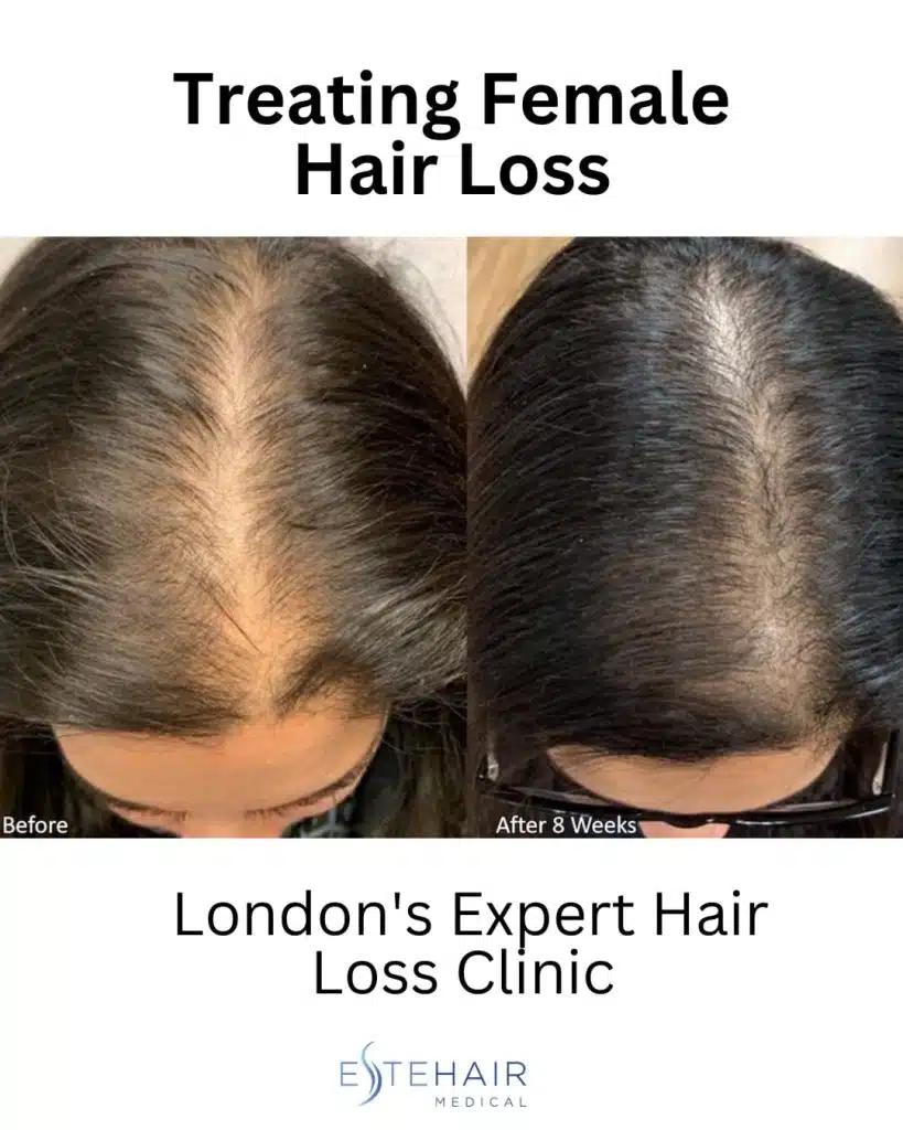 Before and After Este Hair Medical