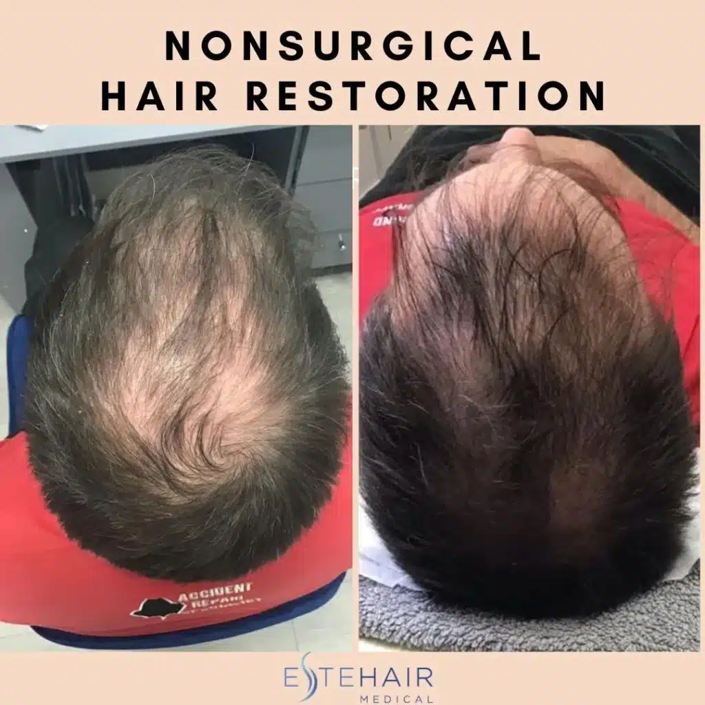 Before and After Este Hair Medical