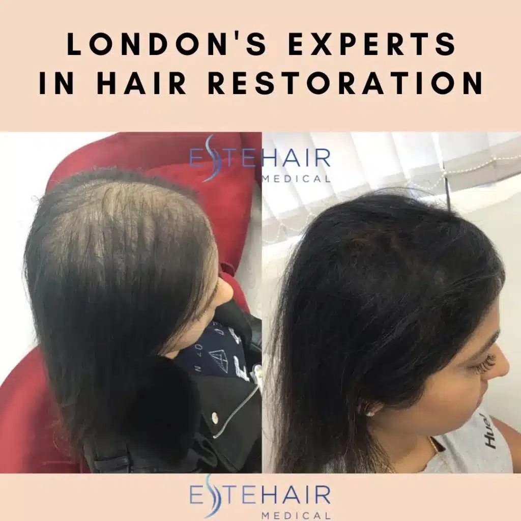 Before and After Este Hair Medical