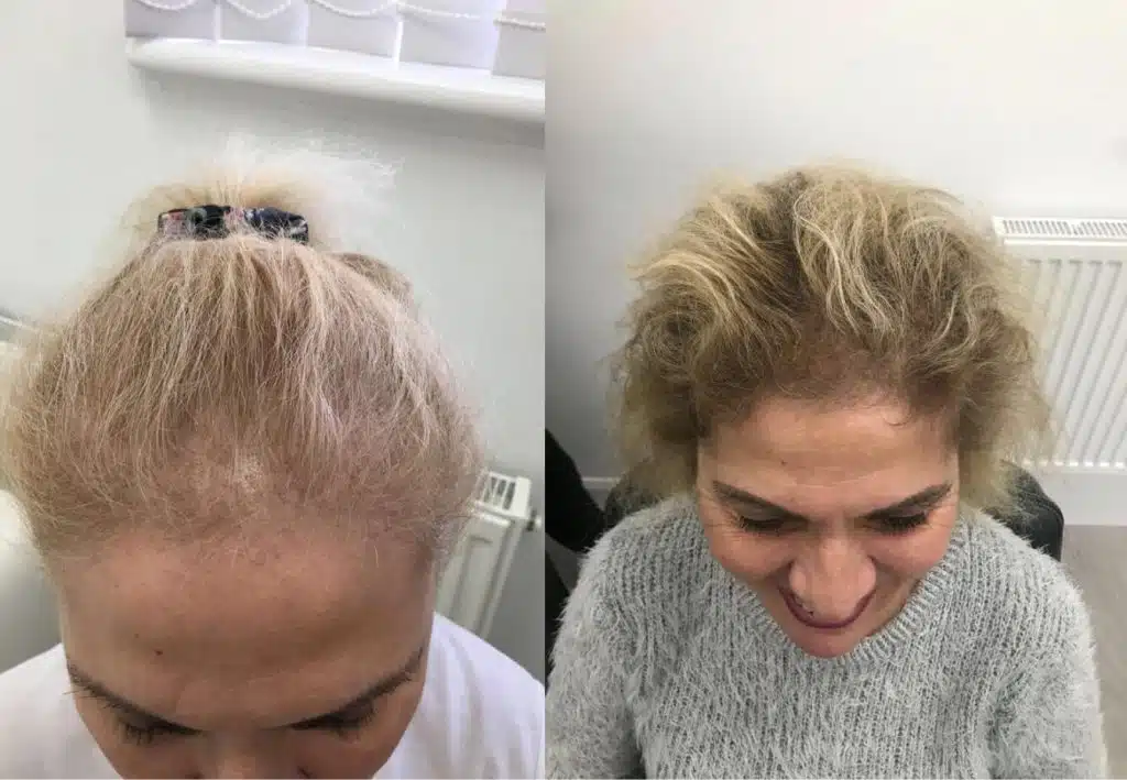 Before and After Este Hair Medical