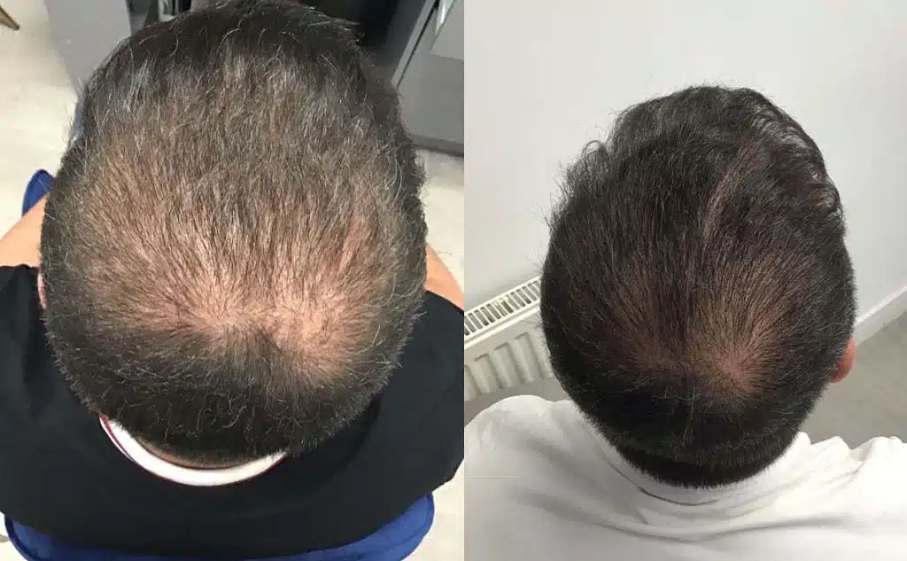 Before and After Este Hair Medical