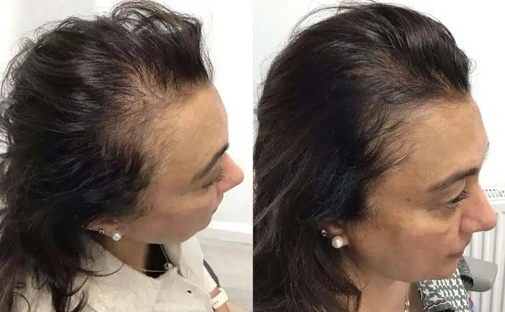 Before and After Este Hair Medical