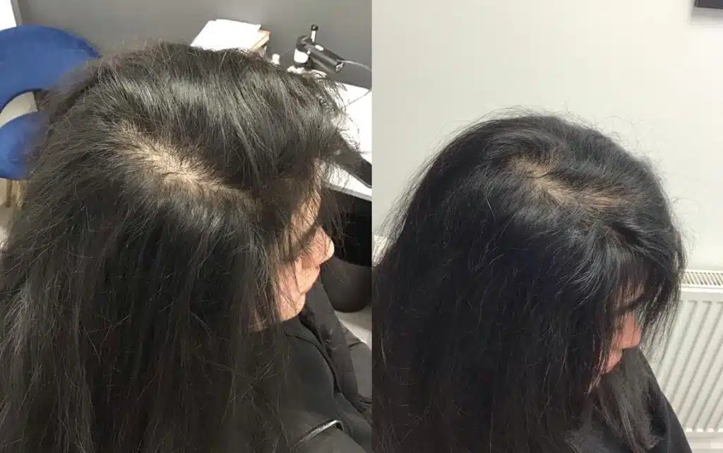 Before and After Este Hair Medical