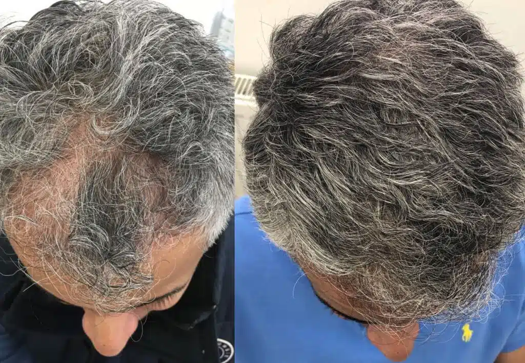 Before and After Este Hair Medical
