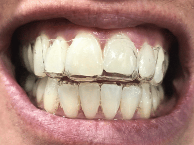 Clear Aligners For Crooked Teeth