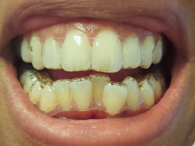 Clear Aligners For Crooked Teeth