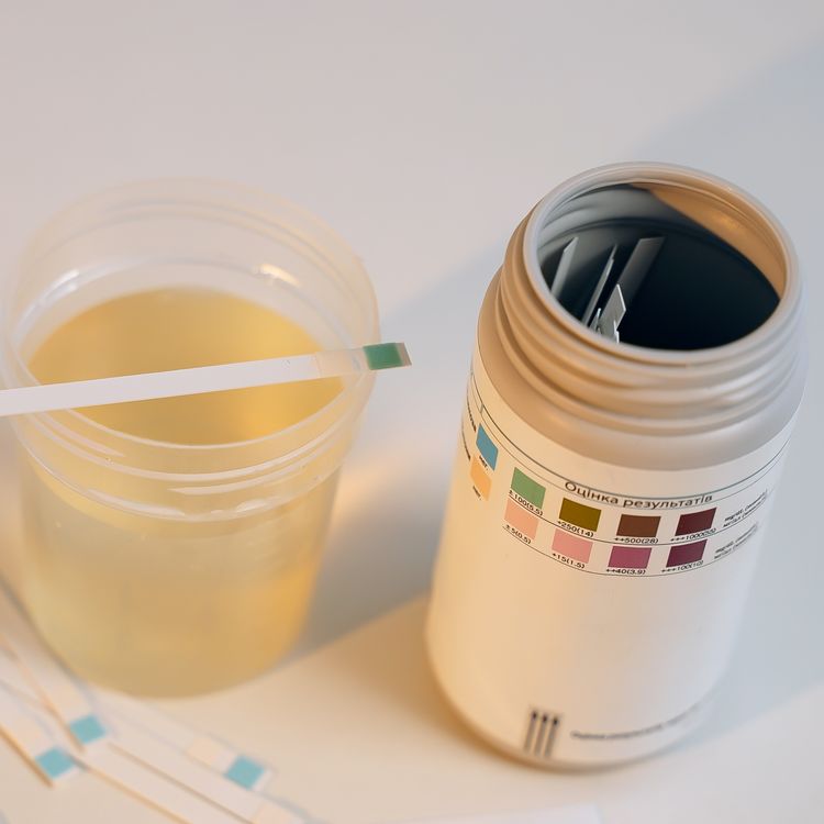 Ketonuria Causes, Symptoms, Diagnosis, and Treatment