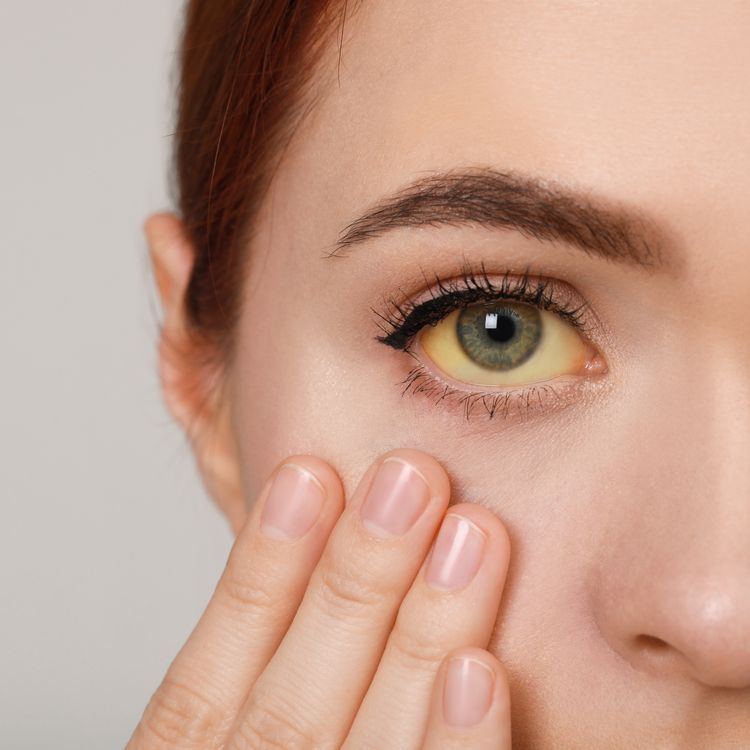Understanding Yellow Eyes Common Causes