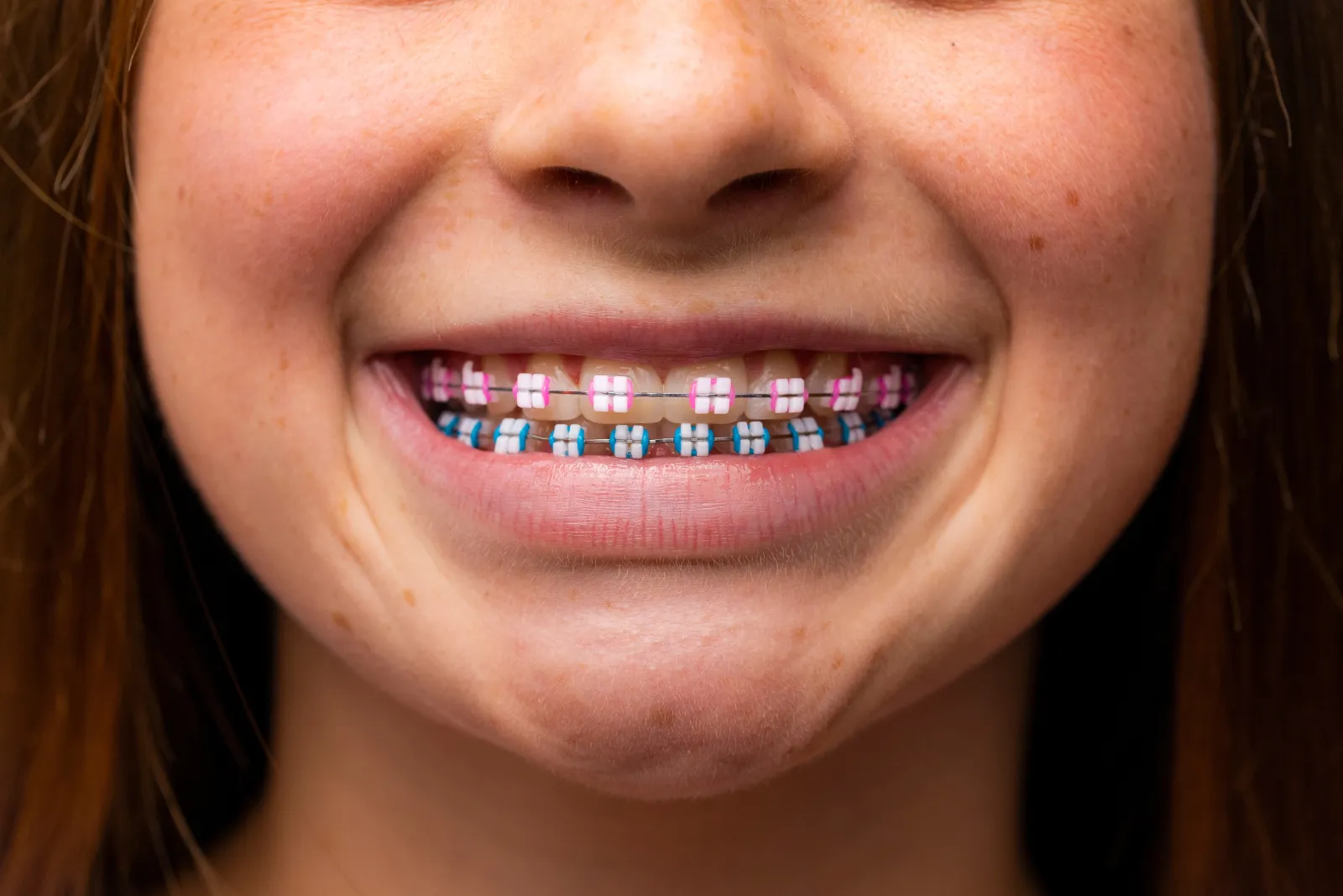 Braces in Covington Blanchard Orthodontics