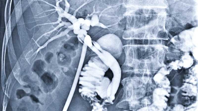 Cholangiography | Gallbladder Dye X-Ray Los Angeles