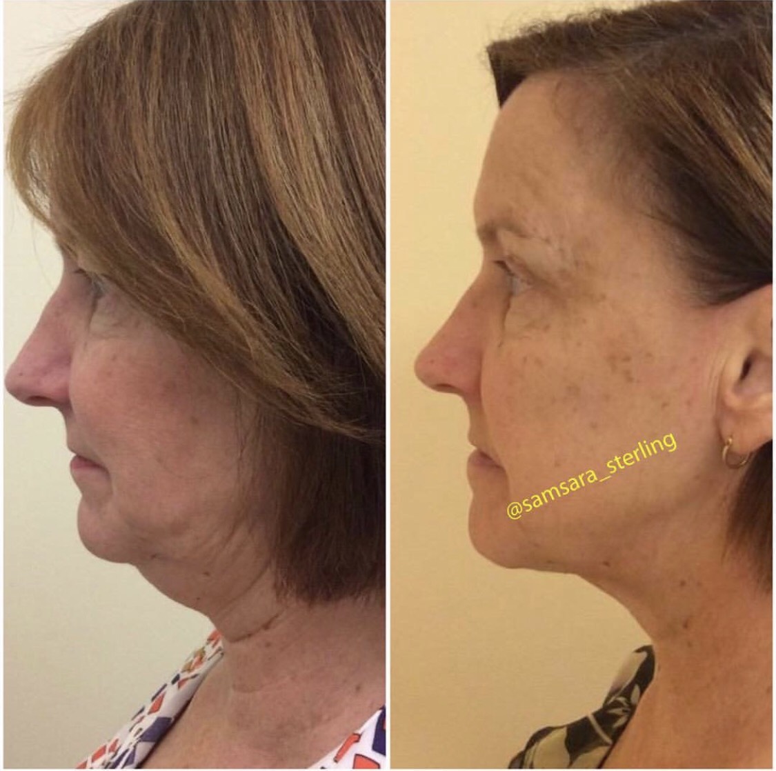 Kybella vs CoolSculpting WA, TX & CA SkinSpirit