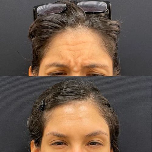 BOTOX® & Dysport Injectors Botox Near Me