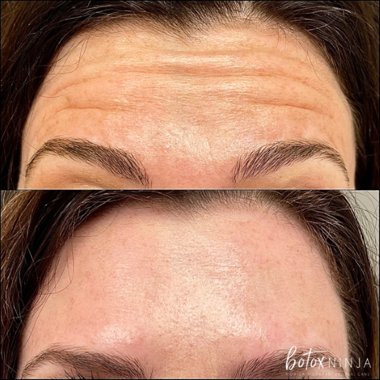 BOTOX® & Dysport Injectors Botox Near Me