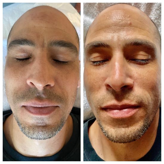 Microdermabrasion Near Me Master Aestheticians SkinSpirit