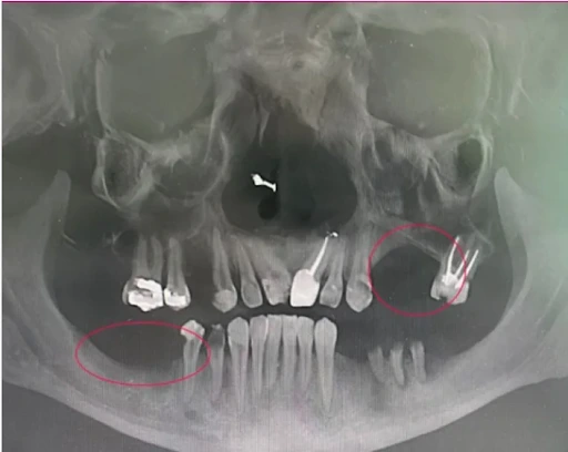 Dental Implant Cost And Information Guide