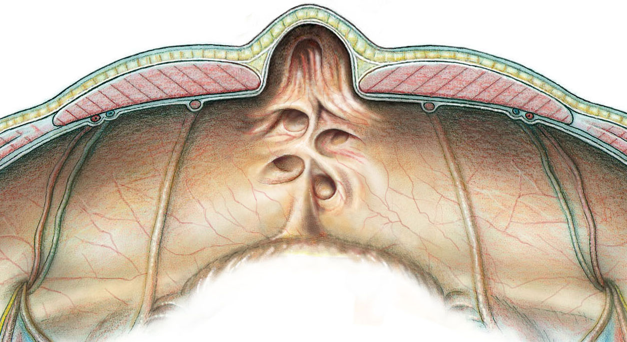 viscera-krankheiten-bauchwand-und-narbenhernie