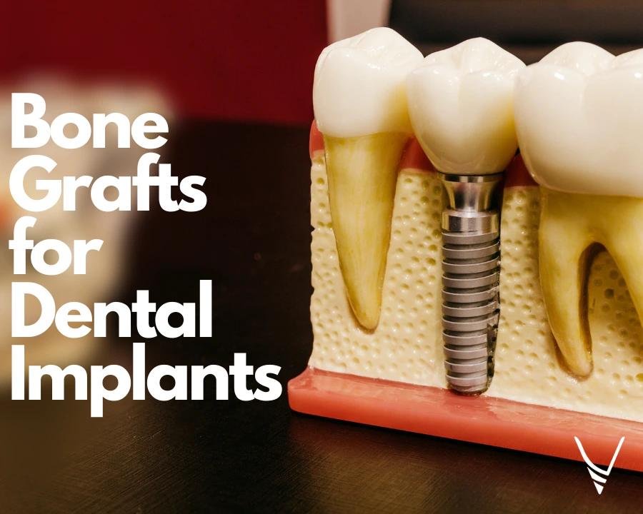 How Bone Grafts Work for Dental Implants
