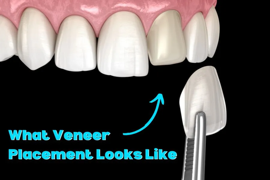 Dentures Vs Veneers The Differences What’s The Better Choice?