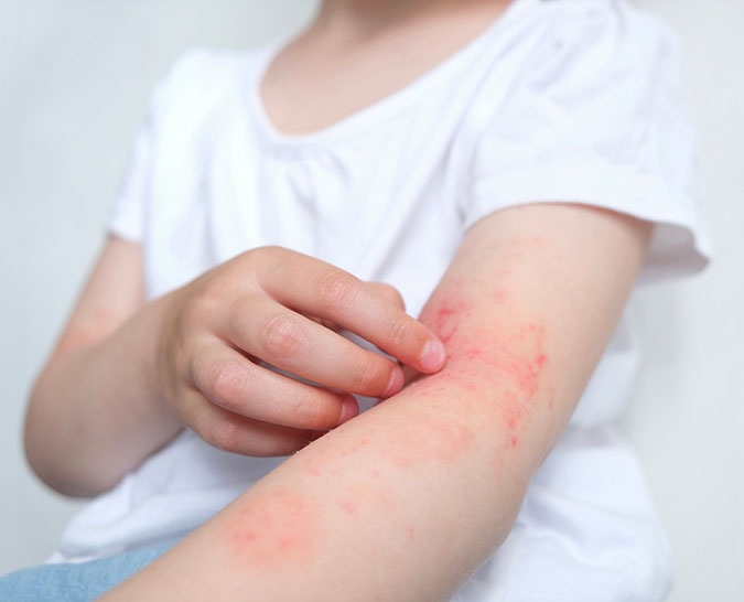 UNDERSTANDING ATOPIC DERMATITIS - A COMPREHENSIVE GUIDE
