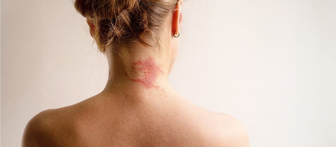 UNDERSTANDING ATOPIC DERMATITIS - A COMPREHENSIVE GUIDE