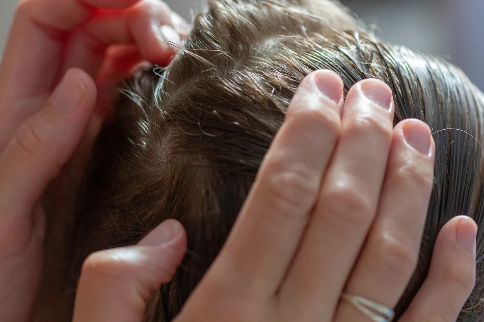 Do Lice Have Wings? Understanding Lice Biology LiceDoctors