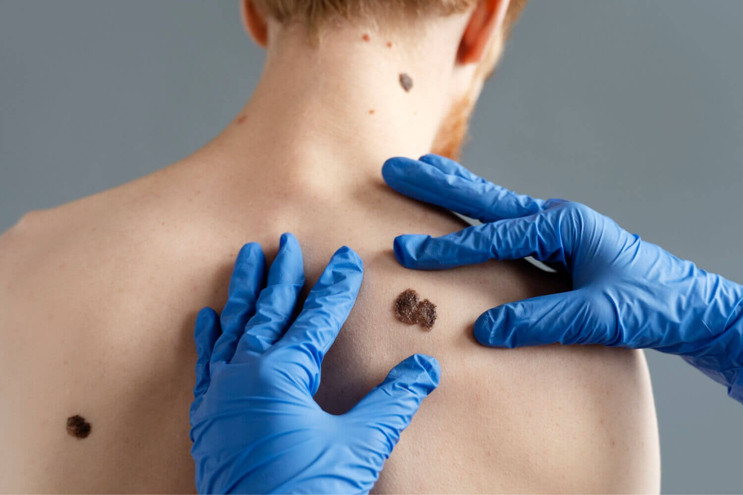 Seborrheic Keratosis Treatment In Charlottesville VA Seborrheic Keratosis Treatment In Charlottesville VA