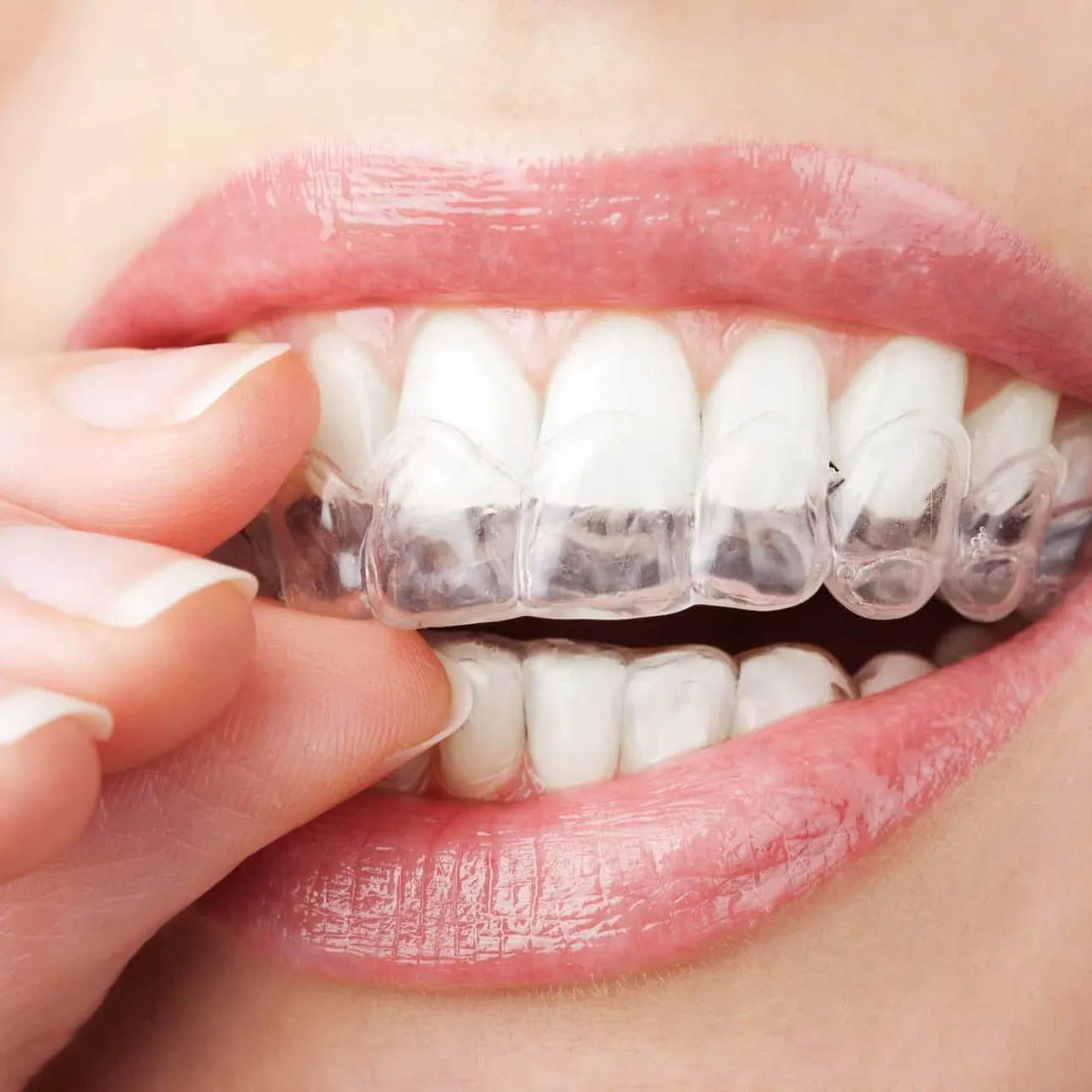 Understanding the Orthodontic Journey What to Expect from Consultation