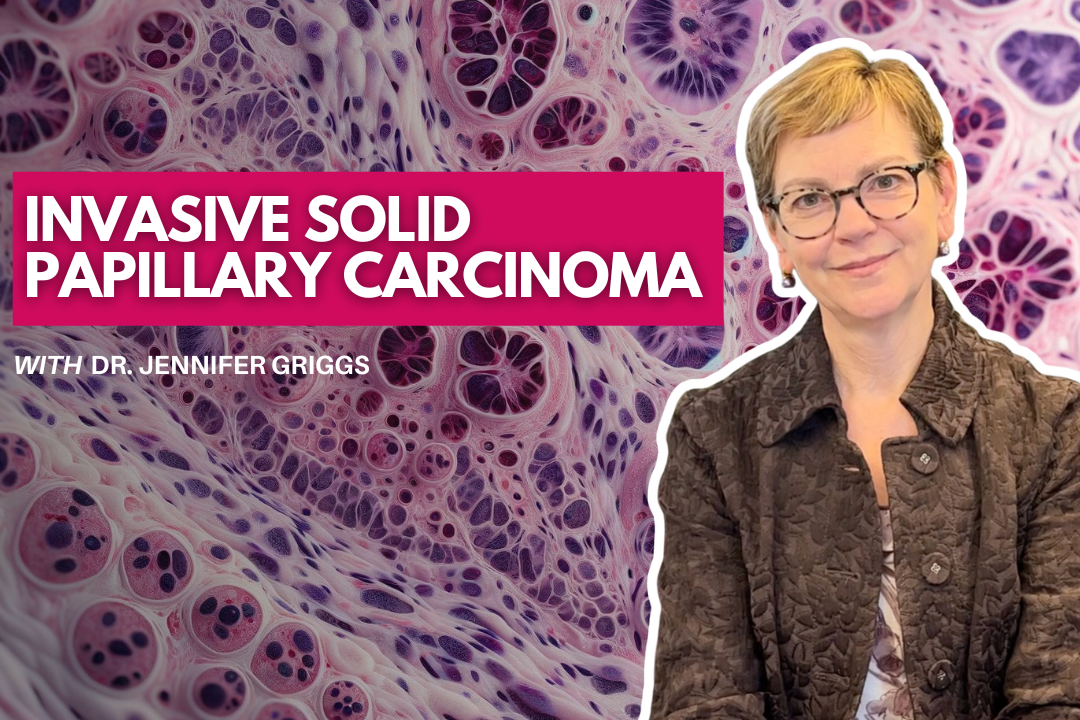What is Invasive Solid Papillary Carcinoma and How is it Treated?