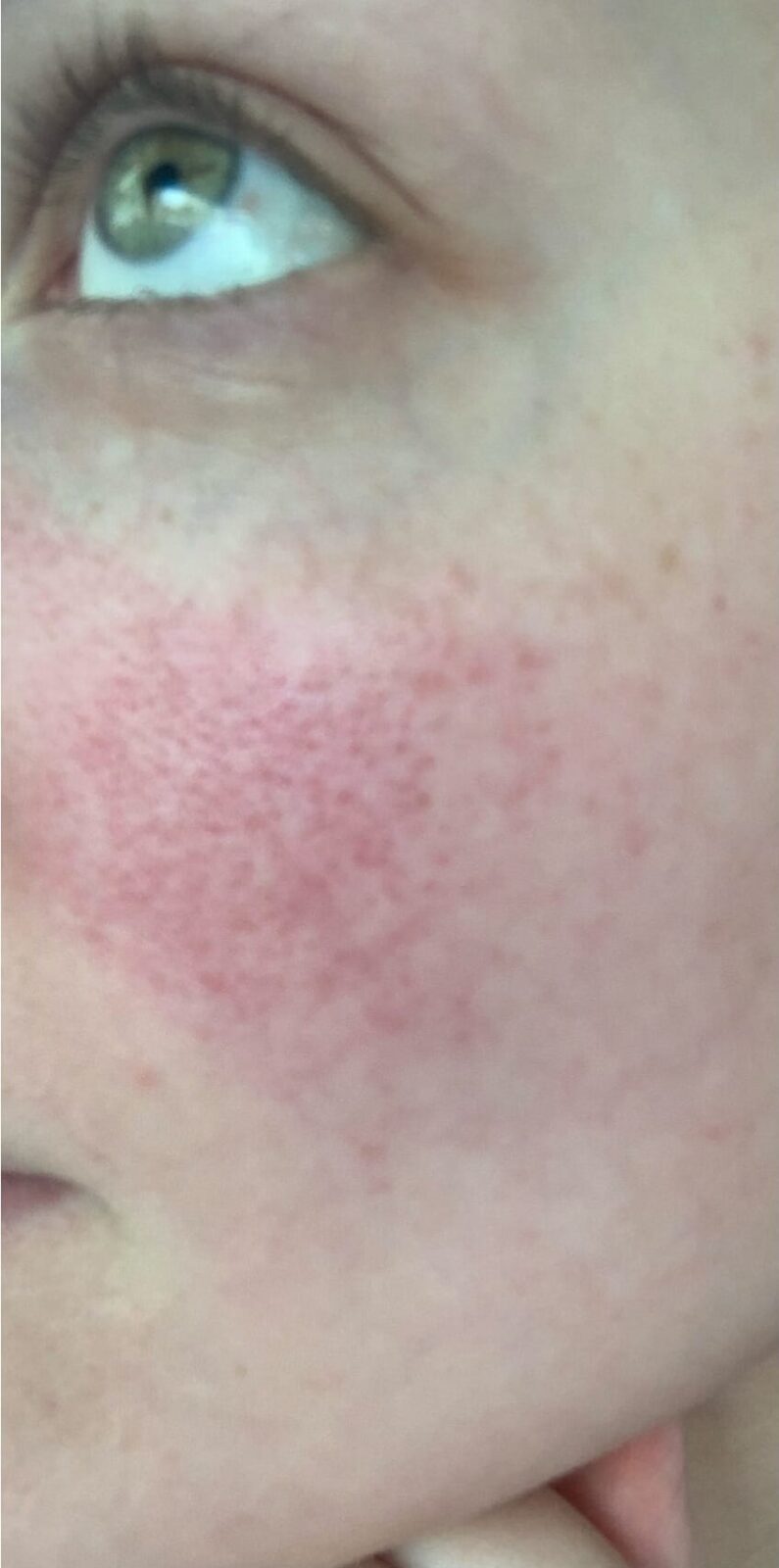 Laser Pigment Fix - Mentor | Northcoast Laser Medspa