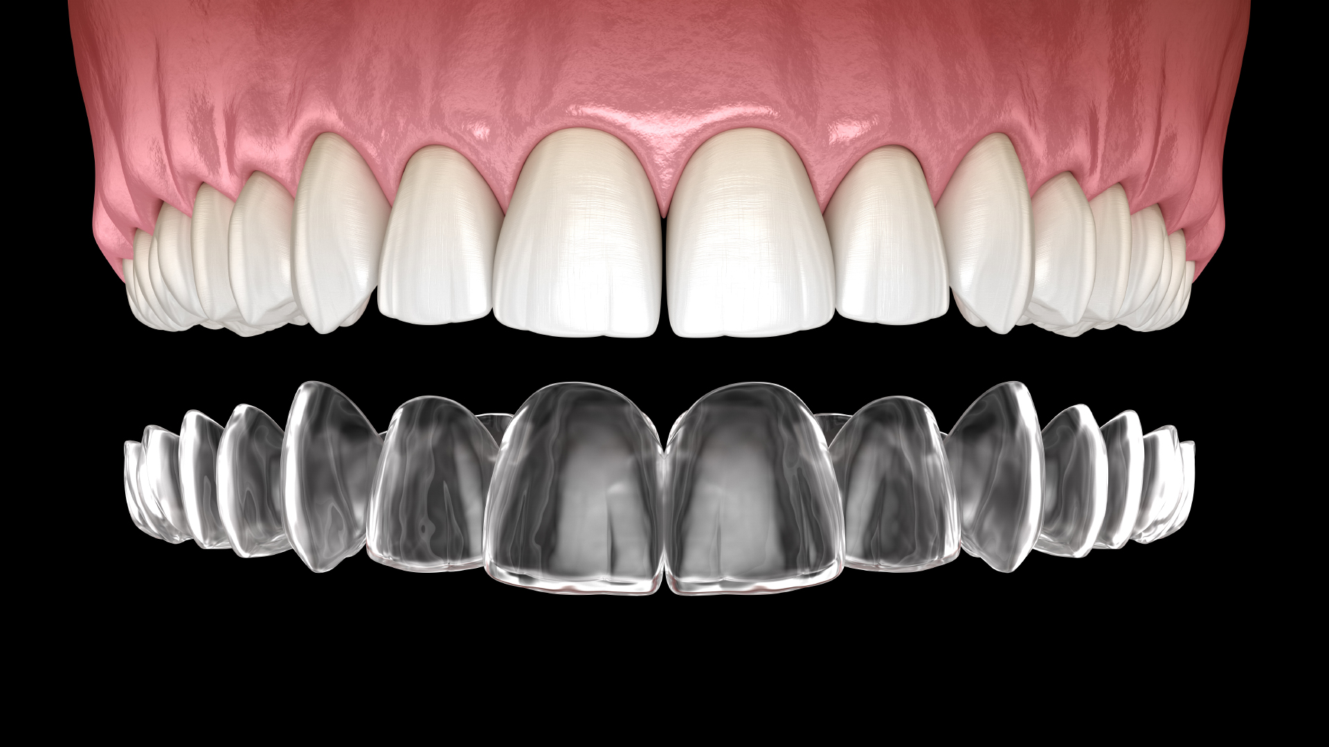 Invisalign